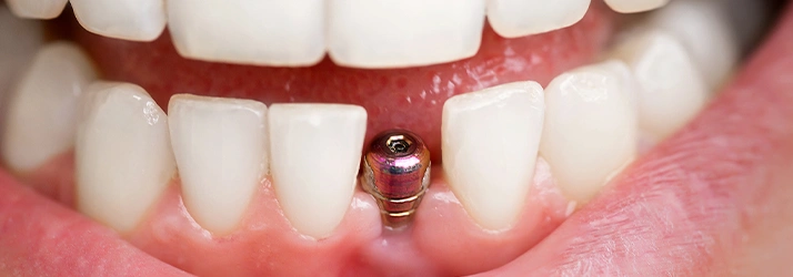 Dental Implants in Spring TX
