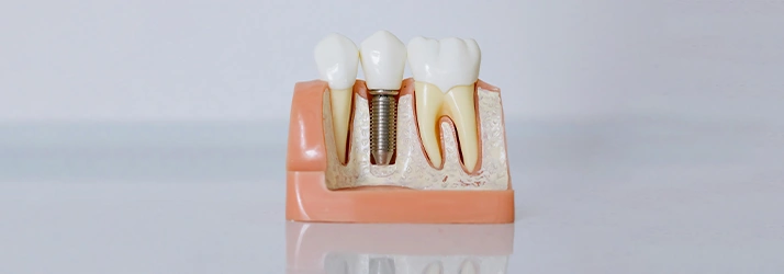 Spring TX Dental Implants