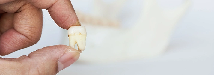 Dental Extractions in Spring TX