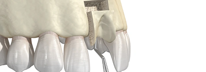 Bone Grafting for Implants in Spring TX: What to Expect During Recovery