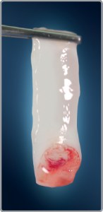 Thin layer of platelet rich fibrin