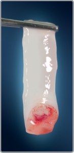 Thin layer of platelet rich fibrin