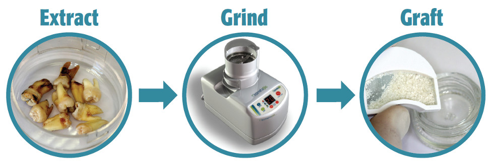Diagram of Dentin Grinder