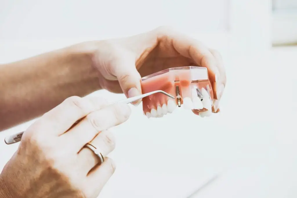 A person holding up a dental implant model